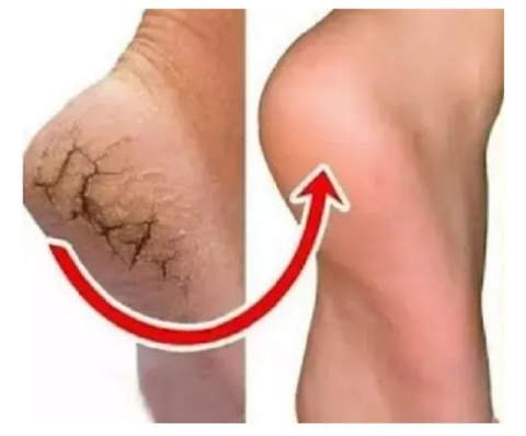 आम समस्या है फटी एड़ियां -शहनाज़ हुसैन